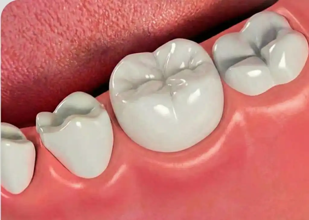 ব্যথাহীন রুট ক্যানাল চিকিৎসা (RCT) পরে