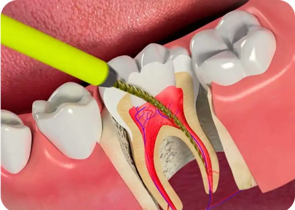 ব্যথাহীন রুট ক্যানাল চিকিৎসা (RCT) পূর্বে